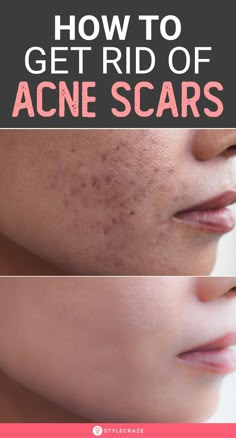 How To Get Rid Of Acne Redness Fast, Best Home Remedy For Acne Scar, Acne Spot Removal, How To Get Rid Of Face Acne, For Acne Remedies, Remedies For Acne Marks, How To Remove Acne And Pimple Marks, How To Lighten Acne Marks, Face Acne Scar Removal