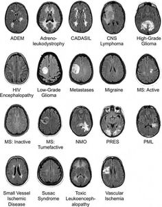 an mri diagram shows the different areas of the brain