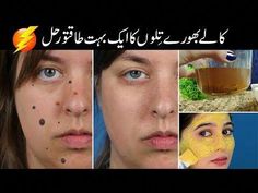 3 Powerful remedies to get rid of black spots, pigmentation, brown spots, black-brown moles, discoloration.😍Previous video for moles and brown spots👇https:... Mole Removal Cream, Moles On Face, Remove Moles, Beauty Tips In Urdu, Baking Soda Cleaning, Brown Spots On Face