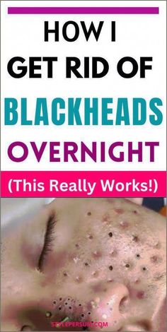 Get Rid of Blackheads For Good – Koperacija Blackheads can be really annoying, especially if they’re consistent. They make your skin rough, and if you leave them untreated for a while, they can even... Blackhead Remedies, Blackheads On Nose, Get Rid Of Pimples, Rid Of Pimples, Anti Wrinkle Treatments, Rid Of Blackheads, Blackheads Removal, Blackhead Removal, How To Get Rid Of Pimples