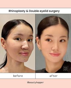 Defined Nose, Trip To Korea, Plastic Surgery Korea, Face Surgery