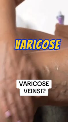 Discover the natural solution to varicose veins with our enlightening video! 💫 Dive into the world of rosemary oil and unlock its powerful properties for treating and soothing those pesky varicose veins.#VaricoseVeins #RosemaryOil #NaturalRemedies #VeinHealth #HealthyLegs #WellnessWednesday #HolisticHealth #NaturalHealing #VaricoseVeins #RosemaryOil #NaturalRemedies #VeinHealth #HealthyLegs #HolisticHealth #NaturalHealing #WellnessWednesday #HealthyLiving #HerbalRemedies #LegHealth #DIYSkincare #AlternativeMedicine #PlantBasedRemedies #BeautyFromNature #SkincareRoutine #HealthyBody #SelfCare #WellnessTips #HealthyHabits Vericose Veins Essential Oil, How To Get Rid Of Vericous Veins, Varicose Veins Exercises, Eye Health Remedies, Vein Health, Varicose Vein Remedy, Natural Health Care