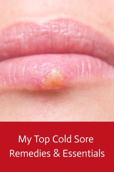 Save this pin to discover my top cold sore remedies to get rid of a cold sore fast! From soothing creams to essential oils, these are the cold sore treatments and products I keep on hand at all times. Cold Sore Remedy Overnight, Cold Sore Remedies, Get Rid Of Cold, Cold Sores Remedies, Cold Sore, Natural Treatments, Keep On, Essential Oils