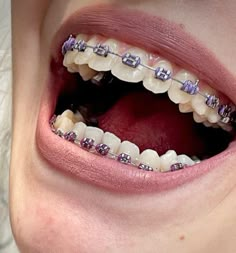 Gray Braces Teeth, Light Purple Braces, Lavender Braces, Brackets Aesthetic, Jewelry Teeth, Braces Colors Ideas, Teeth Gems, Delicious Healthy Food, Cute Braces Colors