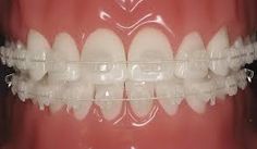 Different Types Of Braces, Braces Ideas, Silver Braces, Kima Sofia, Traditional Braces