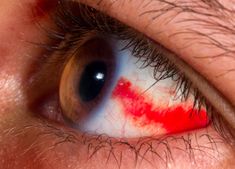 6 Health Issues Your Eyes Can Warn You About – Cleveland Clinic Blood In Eye, Blood Vessel In Eye, Eye Bleed, Eye Health Remedies, Strained Eyes, Blood Pressure Range, Bloodshot Eyes, Eye Twitching