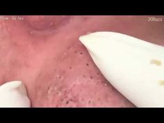 Blackhead Removal Youtube, Poping Pimples Videos New, Pimple Pops Videos, Whitehead Removal On Youtube, Black Heads Popping, Removing Blackheads From Nose Videos, Black Head Remover Diy, Blackheads Removal Video Black Heads, Acne Removal Video