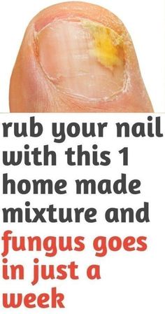 14 Days Challenge: One tablespoon of This Wpies Out Toenail, Foot and Skin Fungus Fast! Nail Care! Toenail Health, Toenail Fungal Infection, Nail Remedies, Toenail Fungus Remedies, Nail Fungus Remedy, Nail Infection, Fungal Nail, Ingrown Toe Nail, Toenail Fungus