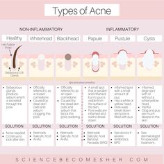 Skincare Knowledge, Right Amount Of Skincare, Skincare Explained, Why Skincare Is Important, Types Of Acne