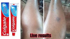 Leg Hyperpigmentation, Getting Rid Of Scars, Colgate Toothpaste, Acne Free Skin