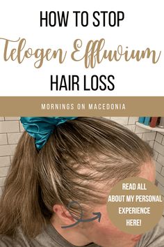 Are you tired of dealing with telogen effluvium, a frustrating and common cause of hair loss? Discover how 'Mornings on Macedonia' could help regain your confidence and transform your life. Dive into a world of knowledge and find the solution you've been searching for. Telogen Effluvium Recovery, Telogen Effluvium, Short I, Long Story Short, Long Story, Hair Starting, Hair Fall, Wedding Beauty, Macedonia