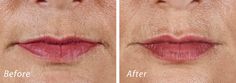 https://flic.kr/p/DNHE1y | Volbella Lip Filler | Volbella Lip Filler Dr. John L. Burns, Jr., MD Board Certified Plastic Surgeon President, Dallas Plastic Surgery Institute Lines Around Mouth, Line Lips, Best Lip Gloss