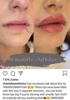 Lip Filler Shape Ideas Black Women, Lip Filler Shape Ideas, Lip Fillers Juvederm, Lip Background, Dermal Fillers Lips, Lips Quotes, Lips Fillers, Lips Shape