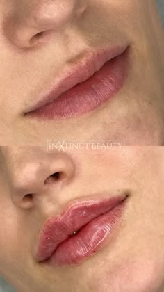 Lip Implants Before And After, Natural Russian Lips, Down Turned Lips, Natural Lip Fillers 0.5ml, Natural Looking Lip Fillers, Lip Filler Natural, Lip Filler Shapes, Russian Lips Filler