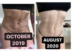 before and after photos of a woman's tummy surgery, showing the results