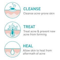 FSA / HSA Eligible Developed with dermatologists, this foaming, creamy cleanser with three essential ceramides cleanses and helps clear acne while leaving skin feeling soft and comfortable. Acne-treatment formula also contains four percent Benzoyl Peroxide to help clear acne pimples & blackheads, prevent new acne from forming & allow skin to heal. This gentle, yet effective cleanser instantly dissolves dirt and oil without stripping skin of its natural moisture, helping to maintain the protectiv Acne Foaming Cream Cleanser, Oily Skin Face, Creamy Cleanser, How To Clear Pimples, Post Acne Marks, Acne Face, Acne Face Wash, Acne Cleansers, Foaming Facial Cleanser