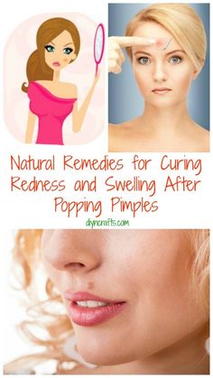 Natural Remedies for Curing Redness and Swelling After Popping Pimples Popping Pimples, Acne Redness, Pimples Under The Skin, How To Get Rid Of Pimples, Skin Remedies, How To Get Rid Of Acne, Beauty Recipe, Skin Tips