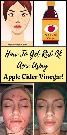 Acv For Acne, Natural Beauty Products Packaging, Apple Cider Vinegar Face, Before And After Acne, Apple Cider Vinegar Face Mask, Apple Cider Vinegar Acne, Face Mask Diy, Diy Acne, Get Rid Of Acne