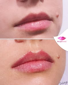 Lip Filler Inspiration, Best Makeup Tutorials, Glossy Eyes, Celebrity Plastic Surgery, Facial Aesthetics, Lip Filler, Lip Fillers, Cosmetology