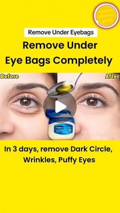 Eye Circle Remedies, Undereye Bags Remedy, Eye Bag Remedies, Eye Health Remedies, Puffy Eyes Remedy, Reduce Eye Bags, Dark Circle Remedies, Remove Eye Bags, Dark Eye Circles