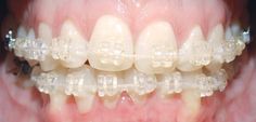 Invisalign Ct Dental Advice, Ceramic Braces, Adult Braces, Teeth Alignment, Brace Face, Braces Colors