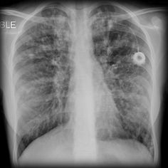 Cystic fibrosis Paranasal Sinuses, System Failure, Lung Infection, Genetic Diseases, Pulmonology, Respiratory Therapy, Lung Disease