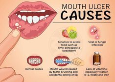 The global mouth ulcer treatment market size was estimated at USD 1.52 billion in 2022 and is anticipated to grow at a CAGR of 3.9% from 2023 to 2030 Ulcer Remedies, Ulcer Remedies Mouth, Mouth Ulcer, Foods For Healthy Skin, Dental Braces, Nail Infection, Cold Symptoms, Acidic Foods