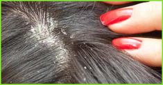 Is Dry & itchy scalp troubling you? We know how it feels when the itching sensation on your scalp gets aggravated. Know how to get rid of dry scalp using remedies Dandruff Causes, Dandruff Solutions, Thick Hair Remedies, Dry Itchy Scalp