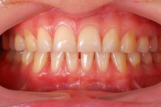 Reverse Receding Gums, Grow Back Receding Gums, Gum Surgery, Kedokteran Gigi, Gum Recession, Sikat Gigi, Teeth Health