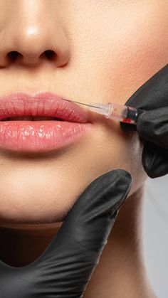 Lip Injections Aesthetic, Armonizacion Facial, Fillers Aesthetic, Botox Cost, Clinic Beauty, Botox Facial