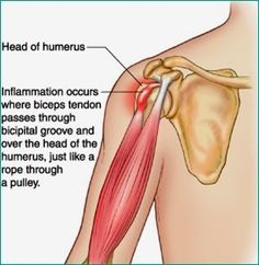 7 Common Reasons Why You Have Shoulder Pain Shoulder Anatomy, Shoulder Posture, Shoulder Impingement, Rotator Cuff Injury, Muscle Anatomy, Shoulder Injuries