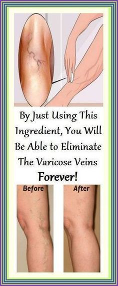 This Natural Ingredient Will Help You Get Rid Of Varicose Veins In Just 3 Days ! Natural Cough Remedies, Cough Remedies, Stubborn Belly Fat, Healthy Tips, Natural Health, Home Remedies