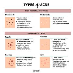 Acne Types And Causes, Different Acne Areas, Where My Acne Is And What It Means, Acne In Different Areas, What Different Areas Of Acne Mean, Acne Types, Different Types Of Acne, Skin Care Supplies, Remove Skin Tags Naturally