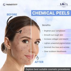 Chemical Peel Facial, Chemical Peel Benefits, Best Chemical Peel, Chemical Face Peel, Healthcare Ads, Facial Benefits, Laser Peel, Skin Doctor, Acne Laser