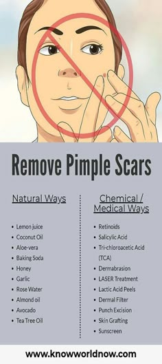 Pimple Scar Removal, Tea Tree Oil Skin, Pimple Scars, Skin Grafting, Clear Healthy Skin, How To Remove Pimples, Healthy Skin Tips