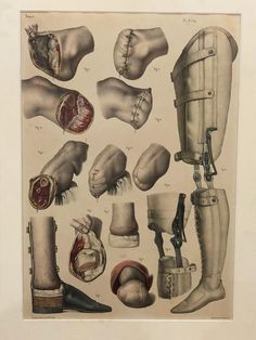 an antique print of foot and ankle injuries