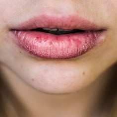 Dry Lips: Causes And Hydrating Lip Care Routine | Eminence Organic Skin Care Sore Lips, Tanning Skin Care, Dry Cracked Lips, Lips Photo, Lip Beauty, Lip Hydration