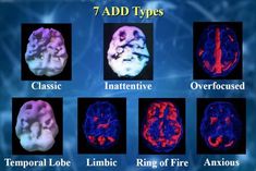 Types of ADD Amen Clinics, Dr Amen, Brain Tips, Brain Mri, Emotional Management, Brain Scans, Brain Images