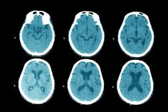 Different Types Of Meditation Change Different Areas Of The Brain, Study Finds Brain Map, Brain Study, Areas Of The Brain, Mindfulness Training, Types Of Dancing, The Human Brain, Mindfulness Exercises