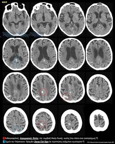 multiple mri images showing different areas of the brain