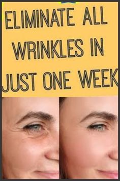 Eliminate wrinkles in just one week Face Wrinkles Remedies, Wrinkles Remedies, Wrinkles Remedies Face, Sagging Cheeks, Homemade Wrinkle Cream, Wrinkle Remedies, Wrinkle Free Skin, Eliminate Wrinkles