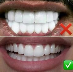 Wisdom Tooth Extraction, Dental Bridge Cost, Laser Teeth Whitening, Smile Teeth, Teeth Implants