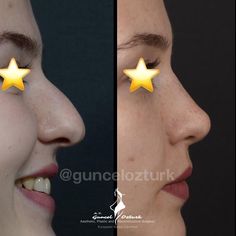 Closed Rhinoplasty, Eye Lift Surgery, Facial Bones