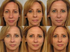 Sculptra Before And After Faces, Sculptra Before And After, Sculptra Injections, Sculptra Filler, Sculptra Aesthetic, Body Surgery, Cosmetic Fillers, Facial Procedure