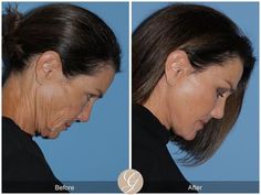 The Difference Between A Deep Plane Facelift & A SMAS Lift | Blog Deep Plane Facelift, Facial Plastic Surgery, Facial Plastic, Skin Remedies, Face Lift, Skin Products, Plastic Surgeon, Cosmetic Surgery, Anti Aging Skin Products