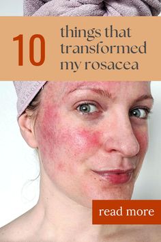 The 10 things that actually helped my rosacea: everything I've learned about rosacea after having it for 20 years. Rosacea tips, rosacea advice, rosacea help. #talontedlex Red Cheeks Remedy, Reduce Redness In Face, Face Redness Remedy, Redness On Face, Inflammation Foods, Red Carpet Makeup, Red Cheeks, Facial Cleansers