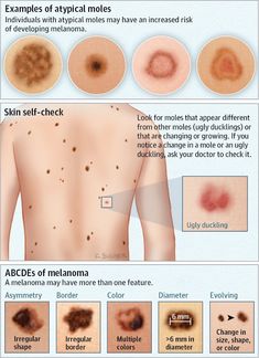 Dermatology Nurse, Colon Health, Medical Facts, Types Of Acne, Health Ideas, Nursing Tips, Wound Care, Nursing Study, Nursing Education