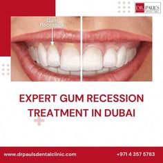 Health Book, Gum Recession, Receding Gums, Gum Health, Health Books, Dental Clinic, Oral Health