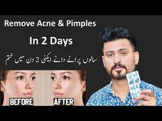 #bestwhiteningcreaminpakistan#removepimples#bestylingPimples, also called acne, occur when your skin’s oil glands are overactive and pores become inflamed. S... Remove Pimples Overnight, Clear Pimples, Clear Skin Remedies, Pimple Cream, How To Clear Pimples, Blind Pimple, Pimples Under The Skin, Nose Picking