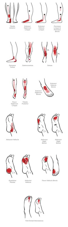 trigger point referral pain patterns for the ankle & foot Myofascial Pain Syndrome, Trigger Point Therapy, Trigger Point, Homemade Seasonings, Trigger Points, Reflexology, Muscle Pain